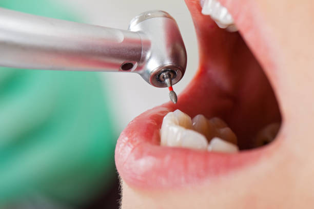 Best Broken or Chipped Tooth Repair in South Sioux City, NE
